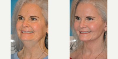 Case 9810 - Woman treated with Laser Resurfacing