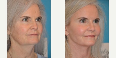 Case 9811 - Woman treated with Laser Resurfacing