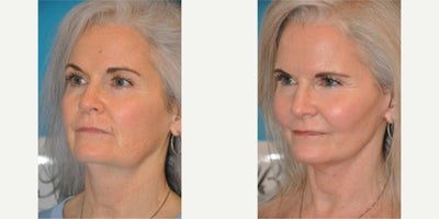 Case 9812 - Woman treated with Laser Resurfacing