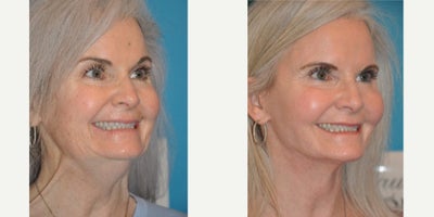 Case 9813 - Woman treated with Laser Resurfacing