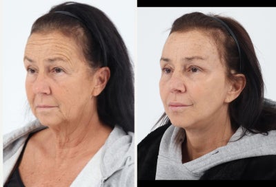 Case 9814 - 65-74 year old woman treated with Brow Lift, Eyelid Surgery, Facelift, Neck Lift, Facial Fat Transfer, Laser Resurfacing