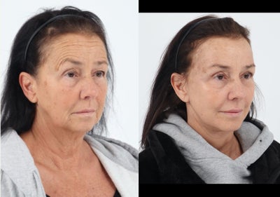 Case 9815 - 65-74 year old woman treated with Brow Lift, Eyelid Surgery, Facelift, Neck Lift, Facial Fat Transfer, Laser Resurfacing