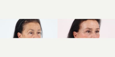 Case 9816 - 65-74 year old woman treated with Brow Lift, Eyelid Surgery, Facelift, Neck Lift, Facial Fat Transfer, Laser Resurfacing