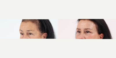 Case 9817 - 65-74 year old woman treated with Brow Lift, Eyelid Surgery, Facelift, Neck Lift, Facial Fat Transfer, Laser Resurfacing