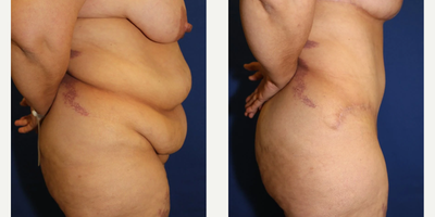 Case 982 - 35-44 year old woman treated with Tummy Tuck