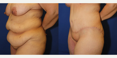 Case 983 - 35-44 year old woman treated with Tummy Tuck