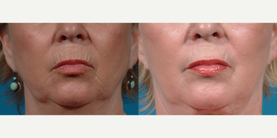 Case 9834 - 65-74 year old woman treated with Laser Resurfacing, CO2 Laser, Halo Laser, ProFractional Laser, YAG Laser