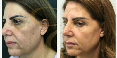Case 9836 - Woman treated with Laser Resurfacing