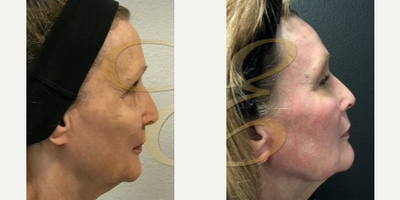 Case 9838 - Woman treated with Laser Resurfacing