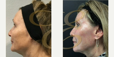 Case 9839 - Woman treated with Laser Resurfacing