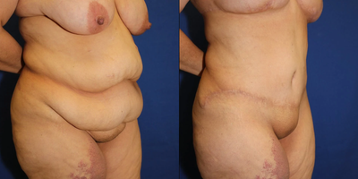 Case 984 - 35-44 year old woman treated with Tummy Tuck