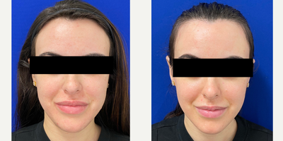 Case 9840 - Woman treated with Laser Resurfacing