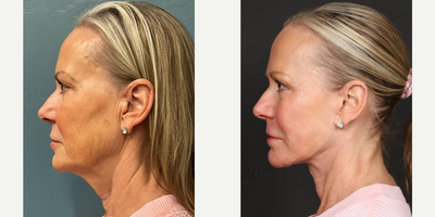 Case 9841 - 65-74 year old woman treated with Deep Plane Facelift, Laser Resurfacing, Facial Fat Transfer