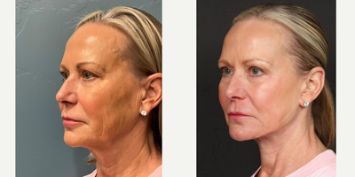Case 9842 - 65-74 year old woman treated with Deep Plane Facelift, Laser Resurfacing, Facial Fat Transfer