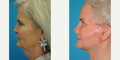 Case 9843 - Woman treated with Laser Resurfacing