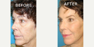 Case 9844 - Woman treated with Laser Resurfacing