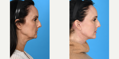 Case 9846 - 55-64 year old woman treated with Deep Plane Facelift, Dermal Fillers, Eyelid Surgery, Facelift, Facial Fat Transfer, Laser Resu