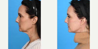 Case 9847 - 55-64 year old woman treated with Deep Plane Facelift, Dermal Fillers, Eyelid Surgery, Facelift, Facial Fat Transfer, Laser Resu