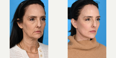 Case 9848 - 55-64 year old woman treated with Deep Plane Facelift, Dermal Fillers, Eyelid Surgery, Facelift, Facial Fat Transfer, Laser Resu