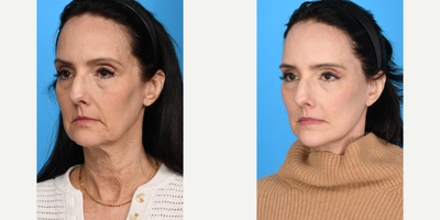 Case 9849 - 55-64 year old woman treated with Deep Plane Facelift, Dermal Fillers, Eyelid Surgery, Facelift, Facial Fat Transfer, Laser Resu