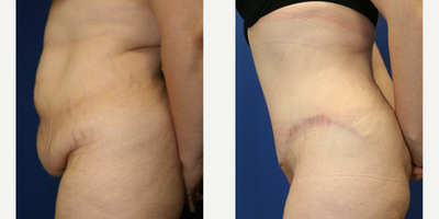 Case 985 - Woman treated with Tummy Tuck