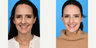 Case 9850 - 55-64 year old woman treated with Deep Plane Facelift, Dermal Fillers, Eyelid Surgery, Facelift, Facial Fat Transfer, Laser Resu