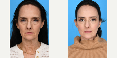 Case 9851 - 55-64 year old woman treated with Deep Plane Facelift, Dermal Fillers, Eyelid Surgery, Facelift, Facial Fat Transfer, Laser Resu