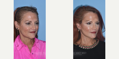 Case 9852 - Woman treated with Laser Resurfacing