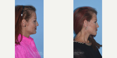 Case 9853 - Woman treated with Laser Resurfacing