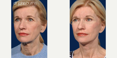 Case 9854 - Woman treated with Laser Resurfacing