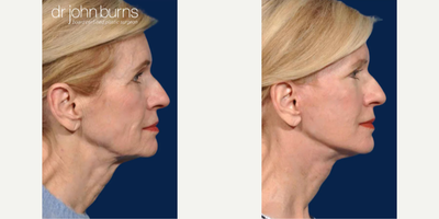 Case 9855 - Woman treated with Laser Resurfacing