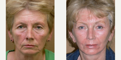 Case 9856 - Woman treated with Laser Resurfacing