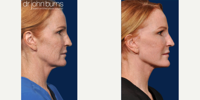 Case 9858 - Woman treated with Laser Resurfacing