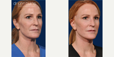 Case 9859 - Woman treated with Laser Resurfacing