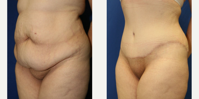 Case 986 - Woman treated with Tummy Tuck