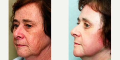 Case 9860 - Woman treated with Laser Resurfacing