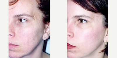 Case 9861 - Woman treated with Laser Resurfacing
