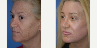 Case 9862 - Woman treated with Laser Resurfacing