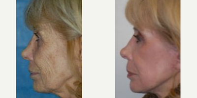 Case 9863 - Woman treated with Laser Resurfacing