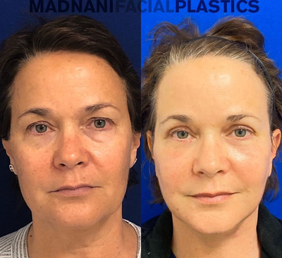 Case 9866 - Woman treated with Laser Resurfacing