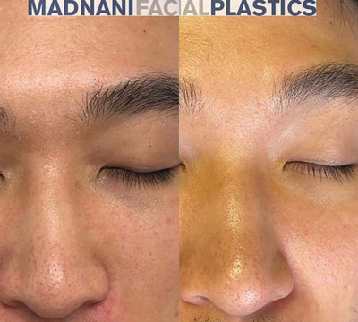 Case 9867 - Man treated with Erbium Laser Resurfacing