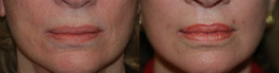 Case 9869 - Woman treated with Laser Resurfacing