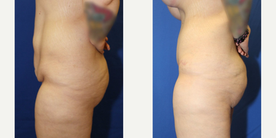 Case 987 - 25-34 year old woman treated with Tummy Tuck