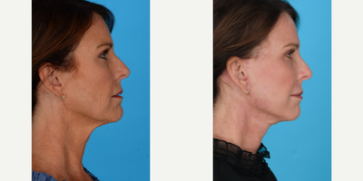 Case 9870 - Woman treated with Laser Resurfacing