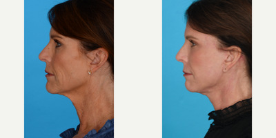 Case 9871 - Woman treated with Laser Resurfacing