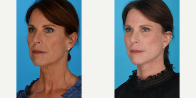 Case 9872 - Woman treated with Laser Resurfacing