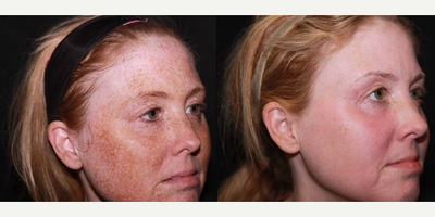 Case 9873 - Woman treated with Laser Resurfacing