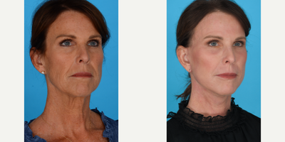 Case 9874 - Woman treated with Laser Resurfacing