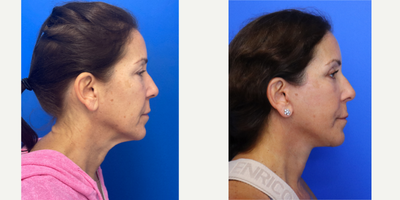 Case 9875 - 55-64 year old woman treated with Facelift, Neck Lift, Eyelid Surgery, Facial Fat Transfer, Laser Resurfacing