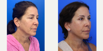 Case 9876 - 55-64 year old woman treated with Facelift, Neck Lift, Eyelid Surgery, Facial Fat Transfer, Laser Resurfacing